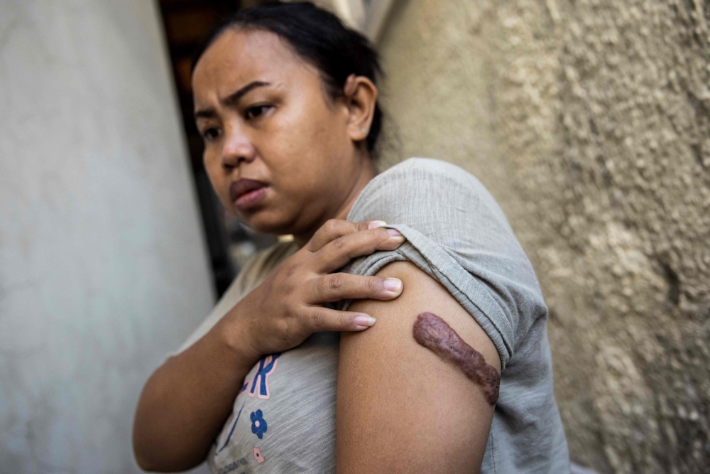 In this file photo taken on October 7, 2022, Indonesian woman Kartika Puspitasari shows a scar on her arm from an injury inflicted by previous employers, at Bethune House, a shelter operated by the migrant worker advocacy group (MFMW), in Hong Kong.(Photo by ISAAC LAWRENCE / AFP)