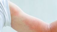 Symptoms of an allergic reaction to insect bites can include rash