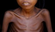 Bare chest of Ismot Ara, 7, a sick Rohingya refugee girl is pictured as she sits on the doorway of her makeshift shelter at Kutupalong refugee camp near Cox's Bazar, Bangladesh November 12, 2017. Reuters/Navesh Chitrakar