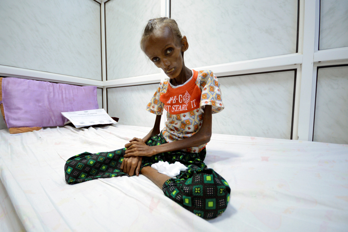 Saida Ahmad Baghili, 18, who is affected by severe acute malnutrition, sits on a bed at the al-Thawra hospital in the Red Sea port city of Houdieda, Yemen October 24, 2016. (REUTERS/Abduljabbar Zeyad)