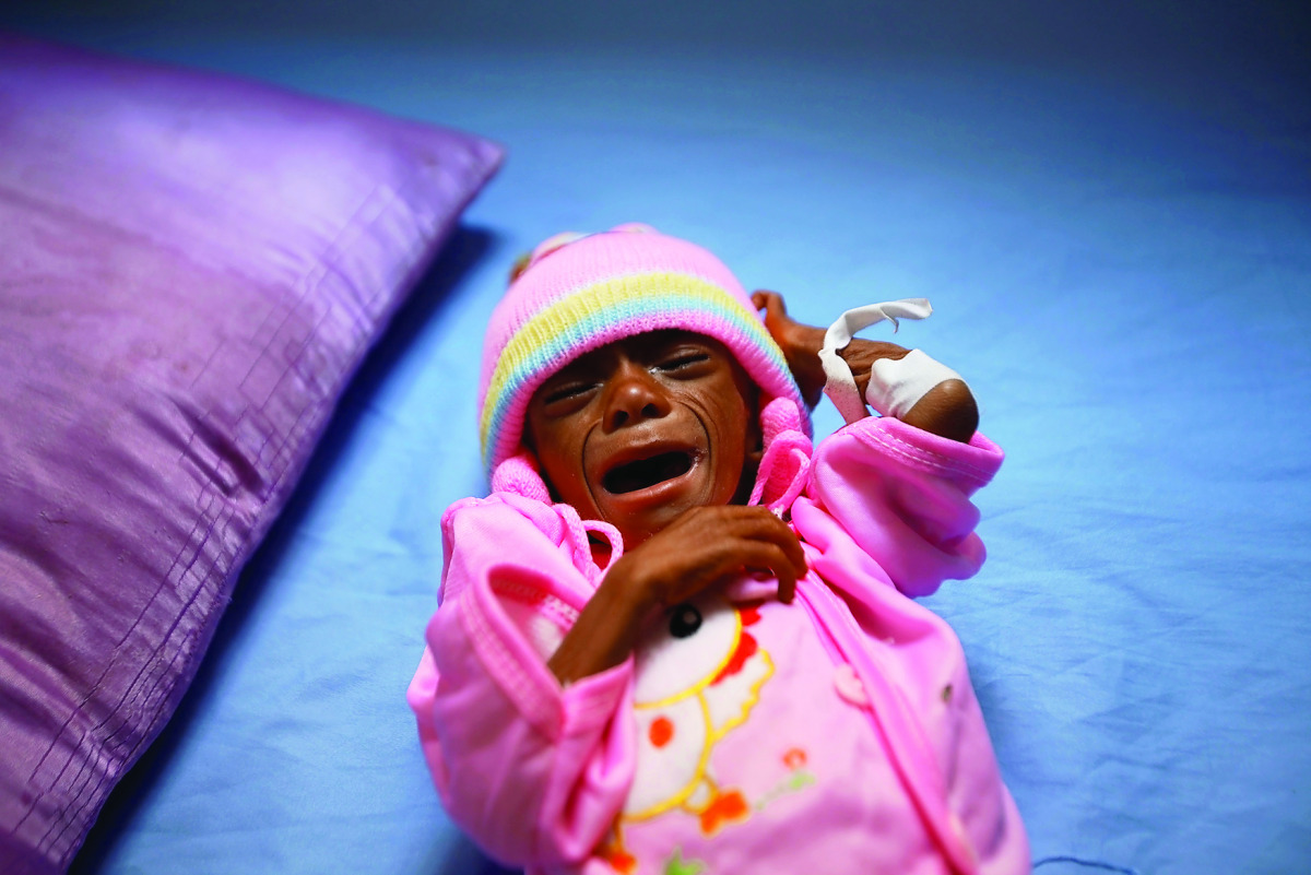 A malnourished boy lies on a bed at a malnutrition intensive care unit in the Red Sea port city of Houdeidah, Yemen. 