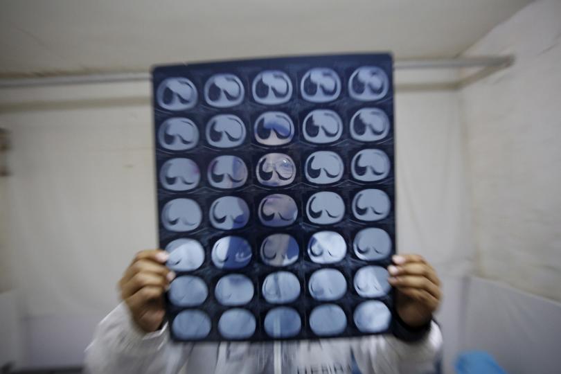 Cancer patient Cao Dongxian poses with CT scan images of his intestine at a hotel room where he stays, near the Peking Union hospital, during an interview with Reuters in Beijing, China, April 6, 2016. Credit: Reuters/Kim Kyung-Hoon 