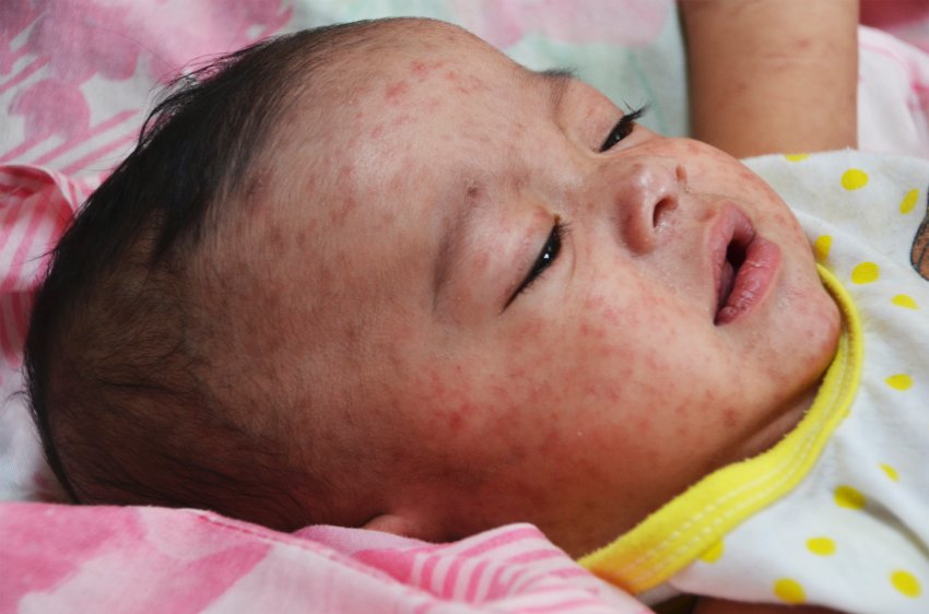 FILE PHOTO: A baby with measles in hospital in Manila, the Philippines, in early 2014. (Photo courtesy: Jim Goodson, M.P.H. / CDC) 