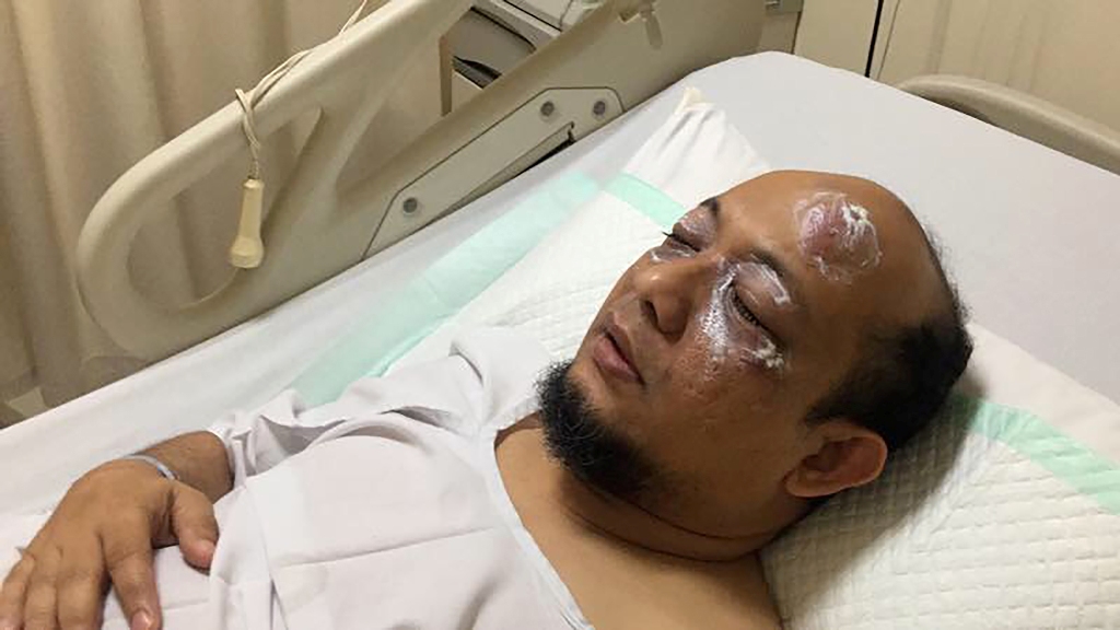 This handout picture taken on April 11, 2017 and released by the Indonesian Police shows Novel Baswedan, a prominent Indonesian corruption investigator, as he gets treatment at a hospital in Jakarta. AFP PHOTO / INDONESIAN POLICE