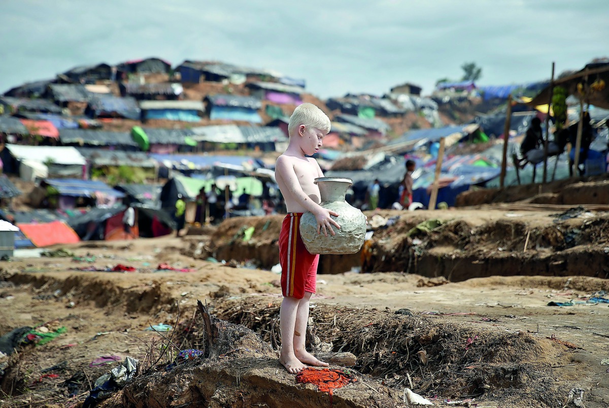 An albino Rohingya refugee poses for a picture in Cox's Bazar, Bangladesh, September 27, 2017. Reuters/Cathal McNaughton