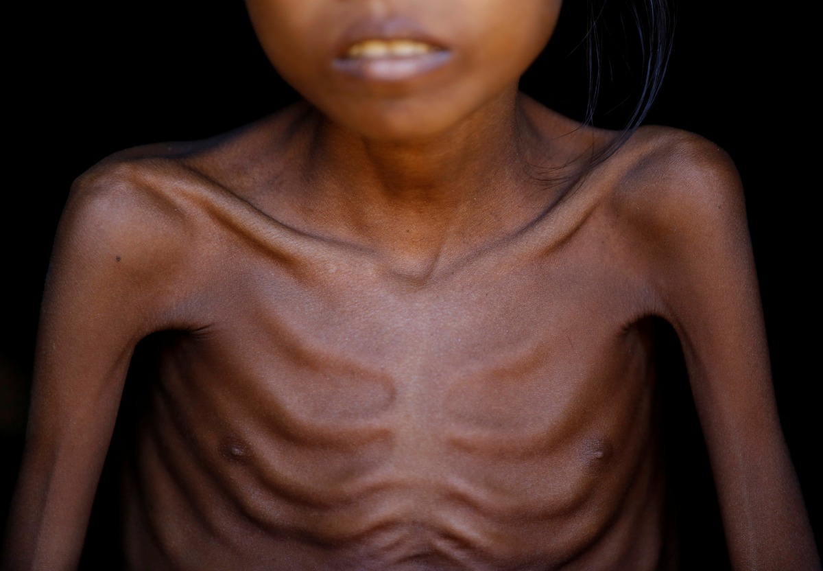 Bare chest of Ismot Ara, 7, a sick Rohingya refugee girl is pictured as she sits on the doorway of her makeshift shelter at Kutupalong refugee camp near Cox's Bazar, Bangladesh November 12, 2017. Reuters/Navesh Chitrakar