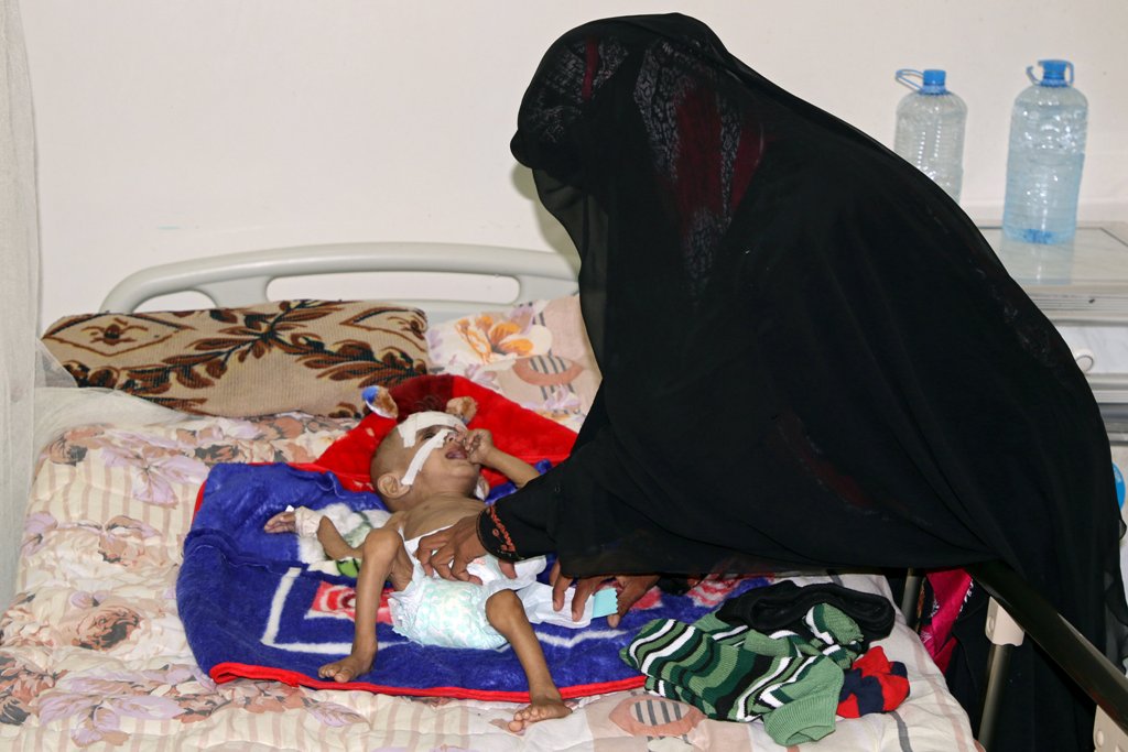 The mother of one-year-old Sameer al-Dhanbari, who suffers from severe malnutrition, helps him as he lies on a bed at a hospital in Houta city, in the southern province of Lahej, Yemen December 5, 2017. Picture taken December 5, 2017. REUTERS/Fawaz Salman
