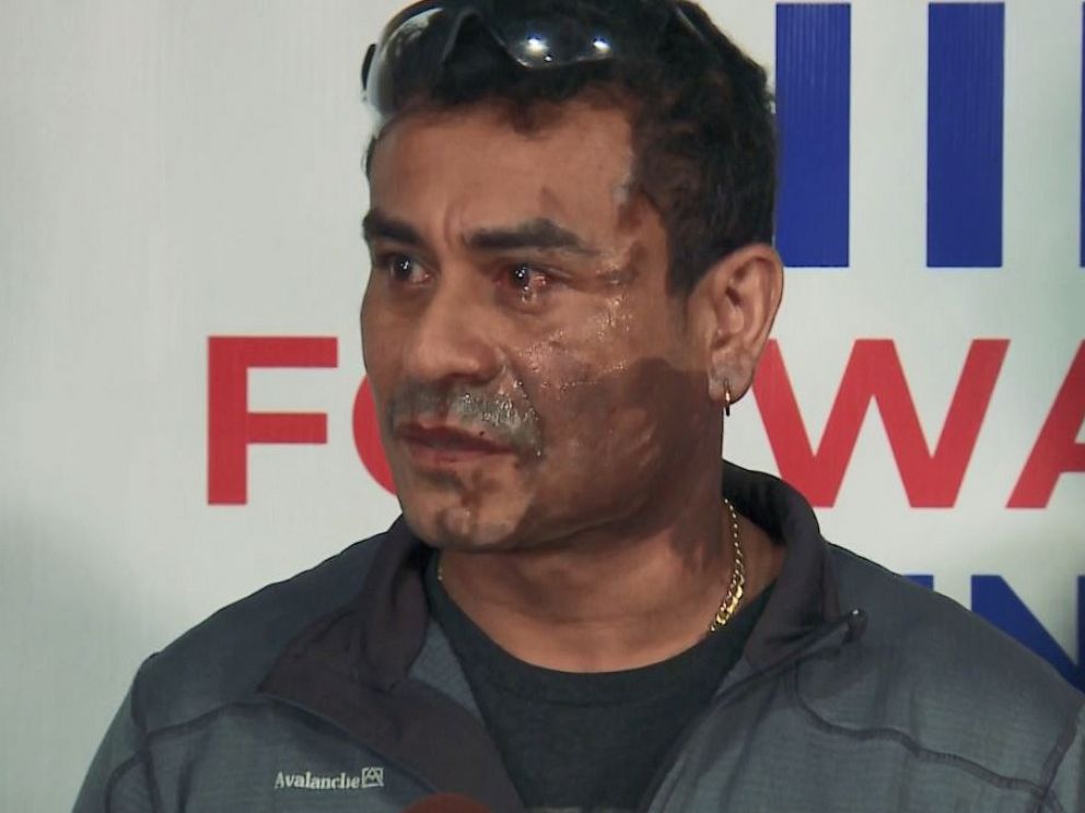 Mahud Villalaz suffered second-degree burns to his face Friday night when he says Blackwell confronted him over the way he parked near a restaurant. 