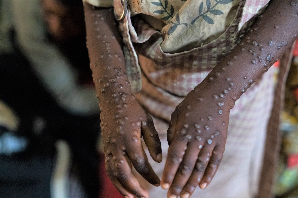 A patient with a severe form of the mpox epidemic is treated at the Kavumu hospital, 30 km north of Bukavu in eastern Democratic Republic of Congo, August 24, 2024. (Photo by Glody Murhabazi / AFP)